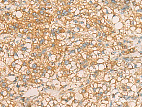 Immunohistochemistry of paraffin-embedded Human liver cancer tissue using AIMP1 Polyclonal Antibody at dilution of 1:40(×200)