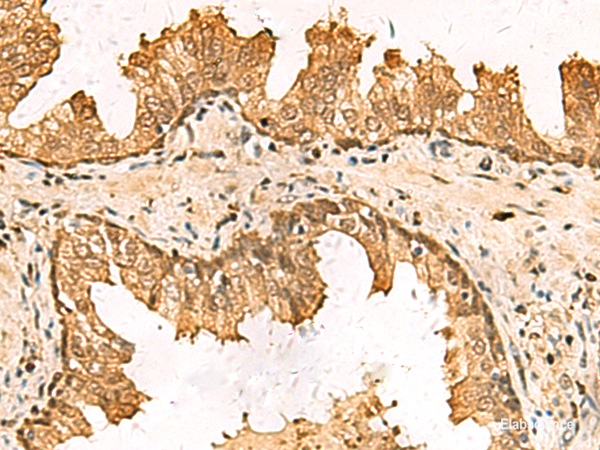 Immunohistochemistry of paraffin-embedded Human prost at e cancer tissue using PDXK Polyclonal Antibody at dilution of 1:75(×200)
