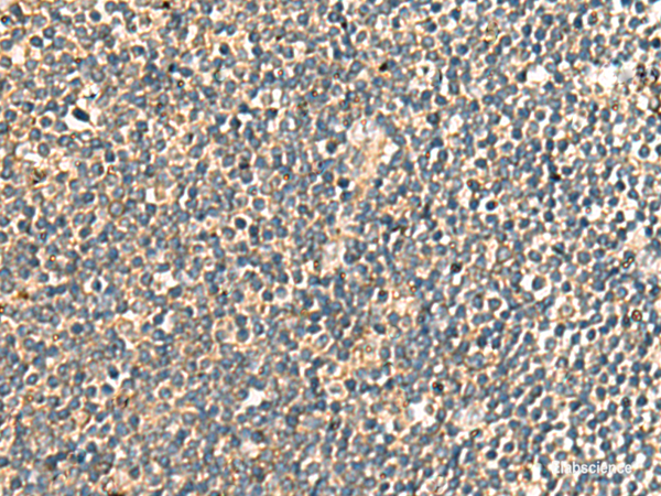Immunohistochemistry of paraffin-embedded Human tonsil tissue using PRKRA Polyclonal Antibody at dilution of 1:60(×200)