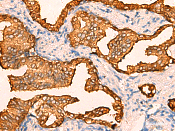 Immunohistochemistry of paraffin-embedded Human prost at e cancer tissue using CRYM Polyclonal Antibody at dilution of 1:60(×200)