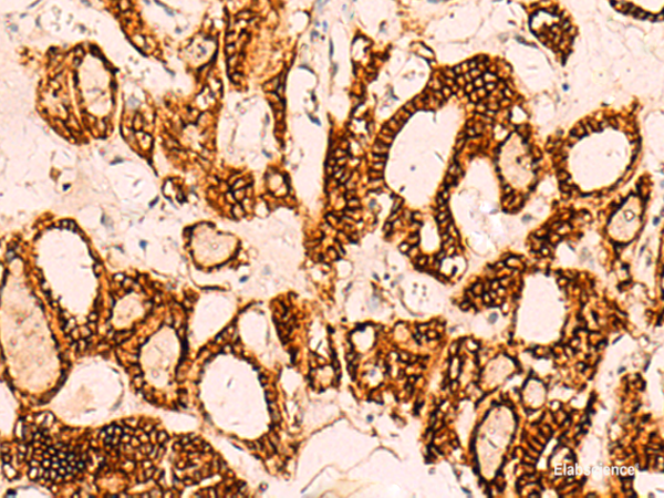 Immunohistochemistry of paraffin-embedded Human thyroid cancer tissue using EPCAM Polyclonal Antibody at dilution of 1:40(×200)