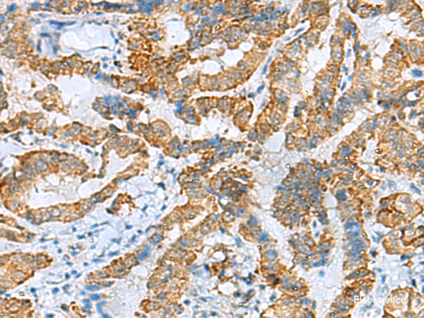 Immunohistochemistry of paraffin-embedded Human thyroid cancer tissue using FBXO8 Polyclonal Antibody at dilution of 1:40(×200)