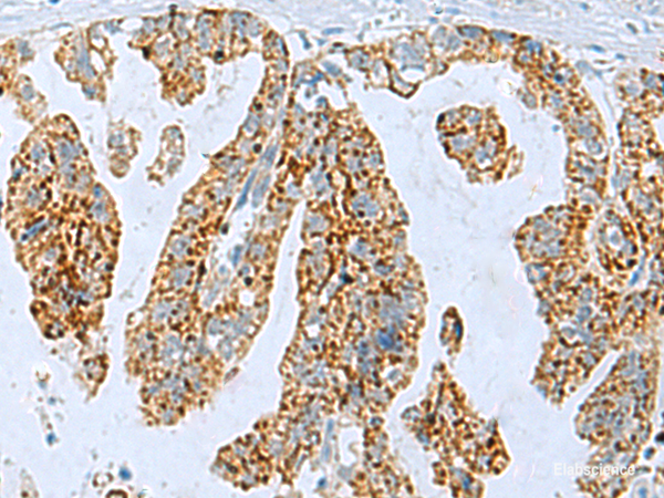 Immunohistochemistry of paraffin-embedded Human gastric cancer tissue using PYCR2 Polyclonal Antibody at dilution of 1:35(×200)
