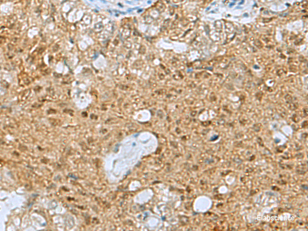 Immunohistochemistry of paraffin-embedded Human ovarian cancer tissue using PTPA Polyclonal Antibody at dilution of 1:60(×200)