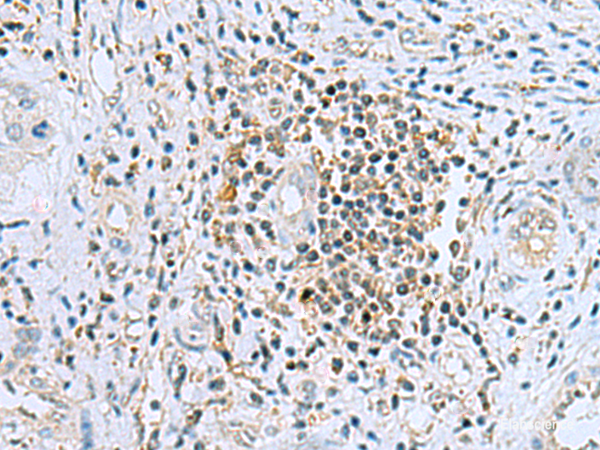 Immunohistochemistry of paraffin-embedded Human liver cancer tissue using DHRS7B Polyclonal Antibody at dilution of 1:80(×200)