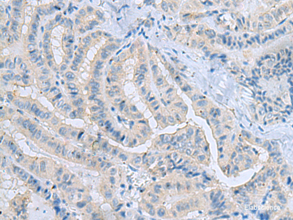 Immunohistochemistry of paraffin-embedded Human thyroid cancer tissue using MSI2 Polyclonal Antibody at dilution of 1:70(×200)