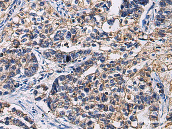 Immunohistochemistry of paraffin-embedded Human gastric cancer tissue using SSH3 Polyclonal Antibody at dilution of 1:55(×200)
