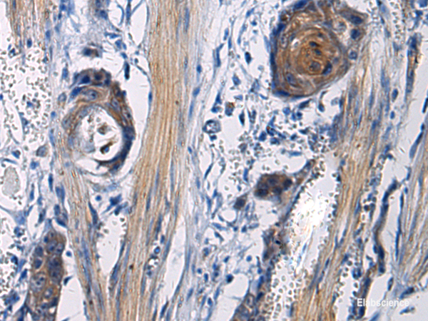 Immunohistochemistry of paraffin-embedded Human esophagus cancer tissue using ICA1 Polyclonal Antibody at dilution of 1:50(×200)
