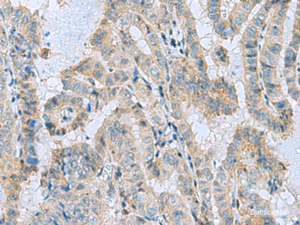 Immunohistochemistry of paraffin-embedded Human thyroid cancer tissue using MGME1 Polyclonal Antibody at dilution of 1:50(×200)