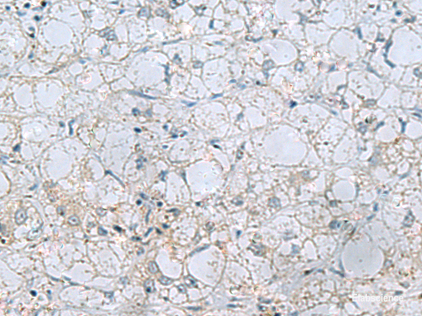 Immunohistochemistry of paraffin-embedded Human liver cancer tissue using NAGK Polyclonal Antibody at dilution of 1:45(×200)