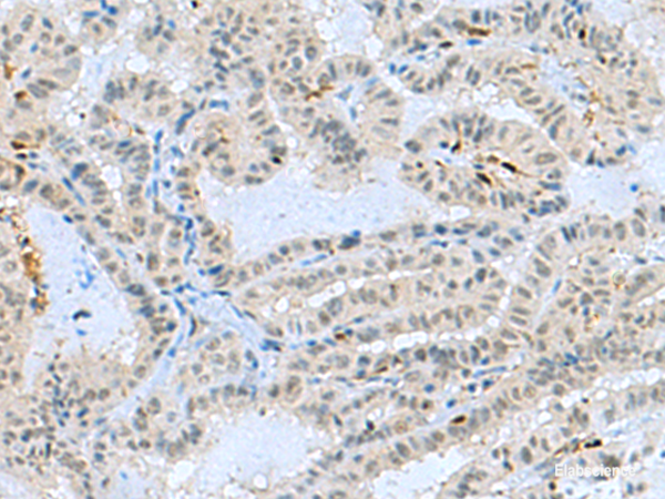 Immunohistochemistry of paraffin-embedded Human thyroid cancer tissue using TCF19 Polyclonal Antibody at dilution of 1:60(×200)