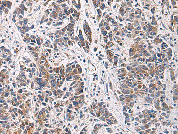 Immunohistochemistry of paraffin-embedded Human colorectal cancer tissue using HSDL2 Polyclonal Antibody at dilution of 1:80(×200)