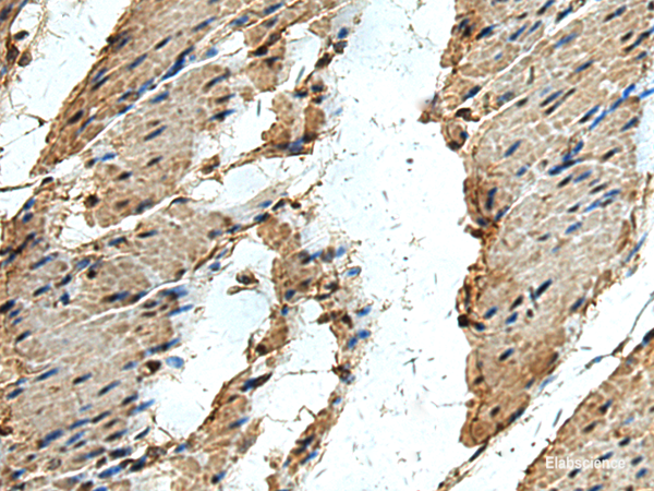 Immunohistochemistry of paraffin-embedded Human thyroid cancer tissue using ERLIN1 Polyclonal Antibody at dilution of 1:50(×200)