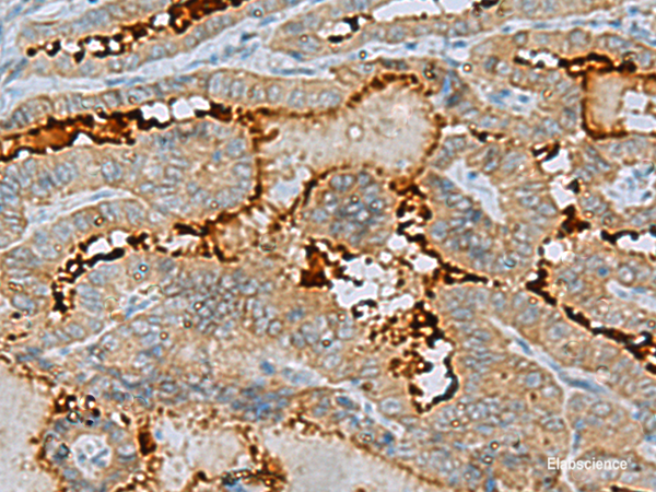 Immunohistochemistry of paraffin-embedded Human thyroid cancer tissue using ENKD1 Polyclonal Antibody at dilution of 1:75(×200)
