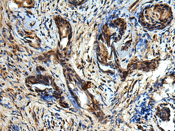 Immunohistochemistry of paraffin-embedded Human prost at e cancer tissue using TBCC Polyclonal Antibody at dilution of 1:80(×200)