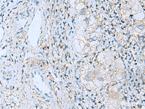 Immunohistochemistry of paraffin-embedded Human liver cancer tissue using EMILIN1 Polyclonal Antibody at dilution of 1:55(×200)
