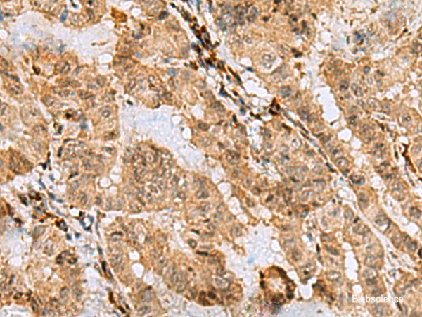 Immunohistochemistry of paraffin-embedded Human thyroid cancer tissue using ASNA1 Polyclonal Antibody at dilution of 1:70(×200)