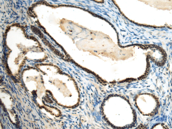 Immunohistochemistry of paraffin-embedded Human prost at e cancer tissue using SUV39H2 Polyclonal Antibody at dilution of 1:70(×200)
