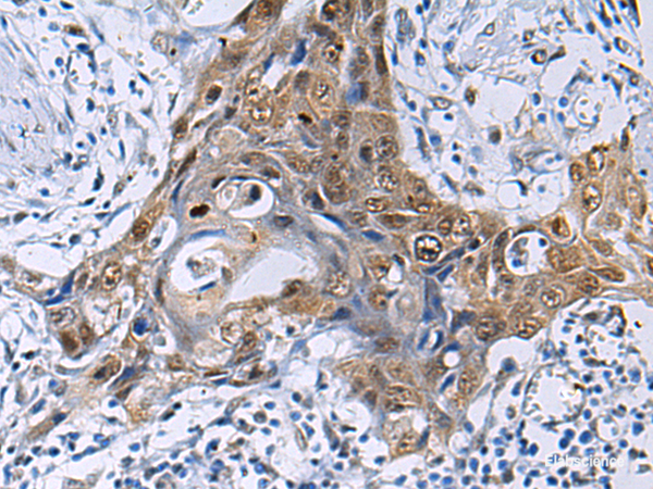 Immunohistochemistry of paraffin-embedded Human esophagus cancer tissue using THOC3 Polyclonal Antibody at dilution of 1:50(×200)