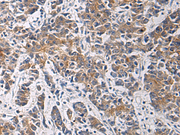 Immunohistochemistry of paraffin-embedded Human colorectal cancer tissue using TMOD3 Polyclonal Antibody at dilution of 1:60(×200)