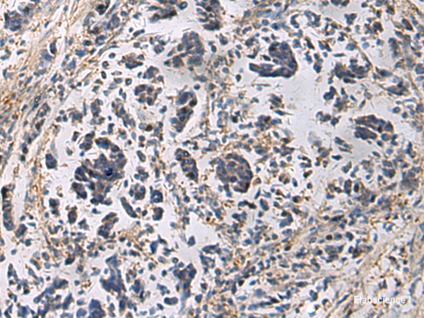 Immunohistochemistry of paraffin-embedded Human breast cancer tissue using GRIK2 Polyclonal Antibody at dilution of 1:60(×200)