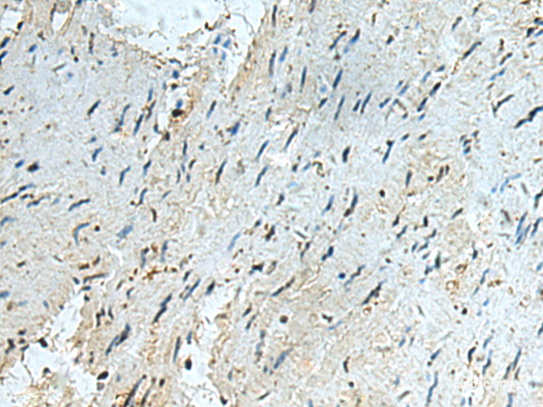 Immunohistochemistry of paraffin-embedded Human gastric cancer tissue using RAPSN Polyclonal Antibody at dilution of 1:40(×200)