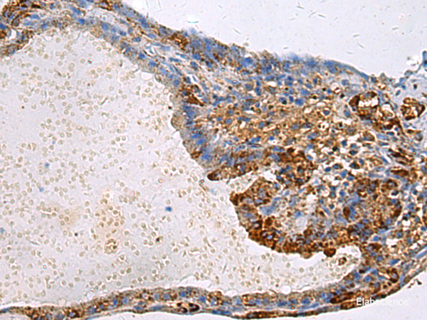 Immunohistochemistry of paraffin-embedded Human thyroid cancer tissue using GNAI1 Polyclonal Antibody at dilution of 1:100(×200)