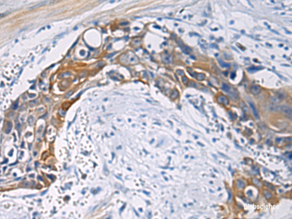 Immunohistochemistry of paraffin-embedded Human esophagus cancer tissue using CEP89 Polyclonal Antibody at dilution of 1:100(×200)