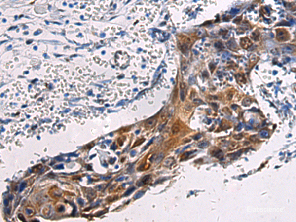 Immunohistochemistry of paraffin-embedded Human esophagus cancer tissue using SORD Polyclonal Antibody at dilution of 1:45(×200)