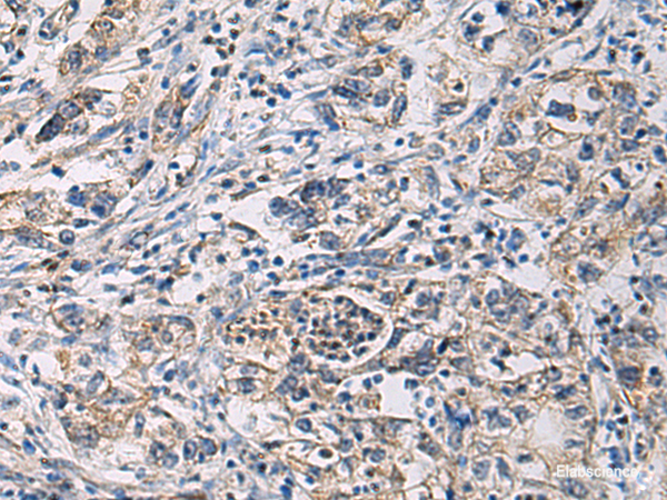 Immunohistochemistry of paraffin-embedded Human gastric cancer tissue using CYTIP Polyclonal Antibody at dilution of 1:100(×200)