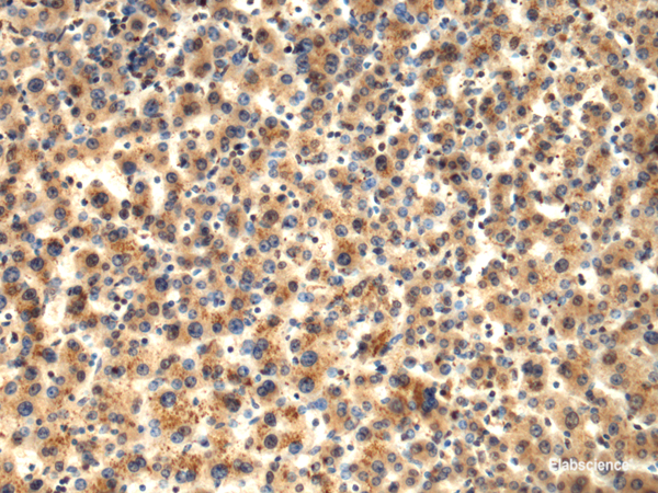 Immunohistochemistry of paraffin-embedded Human liver cancer tissue using TMOD1 Polyclonal Antibody at dilution of 1:65(×200)