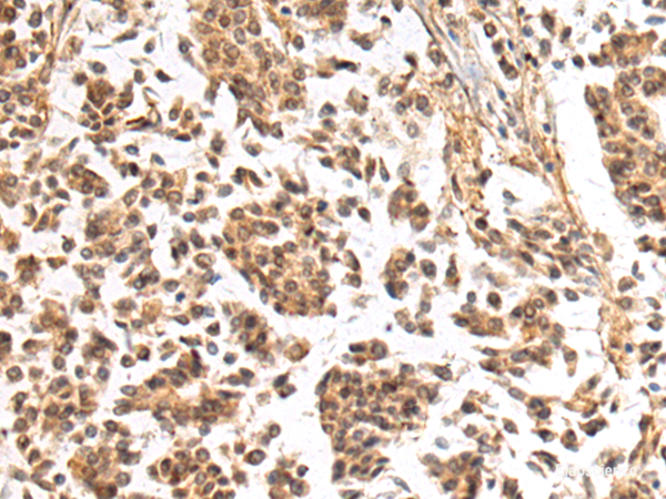 Immunohistochemistry of paraffin-embedded Human breast cancer tissue using NHLRC2 Polyclonal Antibody at dilution of 1:40(×200)