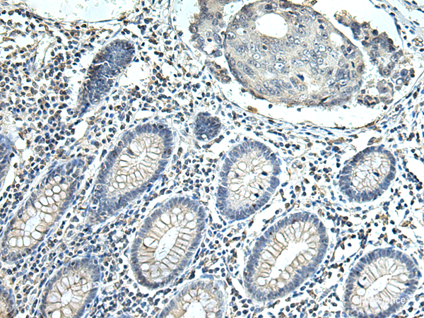 Immunohistochemistry of paraffin-embedded Human colorectal cancer tissue using SLC35F6 Polyclonal Antibody at dilution of 1:115(×200)