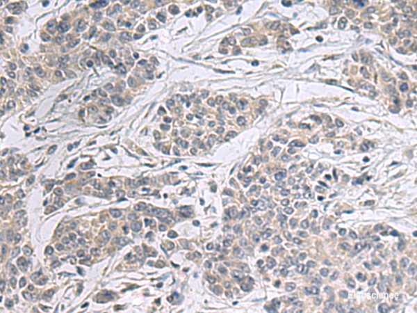 Immunohistochemistry of paraffin-embedded Human colorectal cancer tissue using PPM1K Polyclonal Antibody at dilution of 1:55(×200)