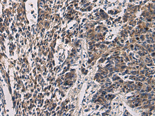 Immunohistochemistry of paraffin-embedded Human colorectal cancer tissue using CCNI Polyclonal Antibody at dilution of 1:60(×200)