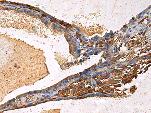 Immunohistochemistry of paraffin-embedded Human thyroid cancer tissue using LYAR Polyclonal Antibody at dilution of 1:60(×200)