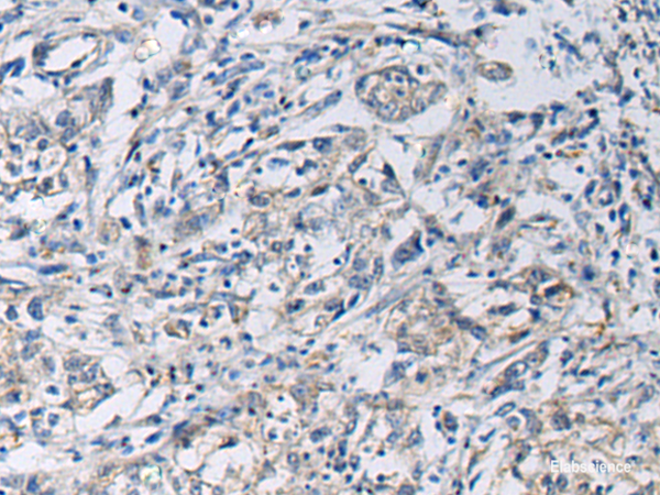 Immunohistochemistry of paraffin-embedded Human gastric cancer tissue using KCNJ10 Polyclonal Antibody at dilution of 1:60(×200)