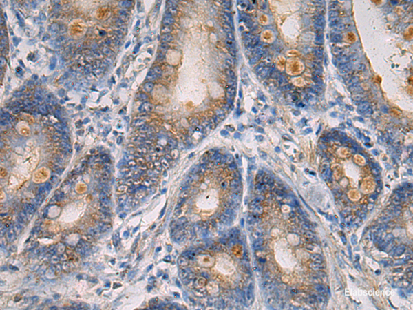 Immunohistochemistry of paraffin-embedded Human gastric cancer tissue using MAPKAPK3 Polyclonal Antibody at dilution of 1:60(×200)