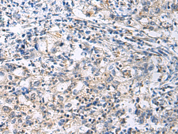 Immunohistochemistry of paraffin-embedded Human gastric cancer tissue using SLC30A3 Polyclonal Antibody at dilution of 1:70(×200)
