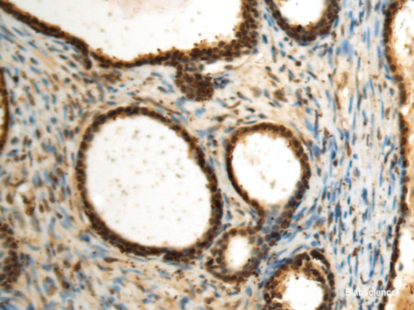 Immunohistochemistry of paraffin-embedded Human prost at e cancer tissue using SEPHS1 Polyclonal Antibody at dilution of 1:85(×200)