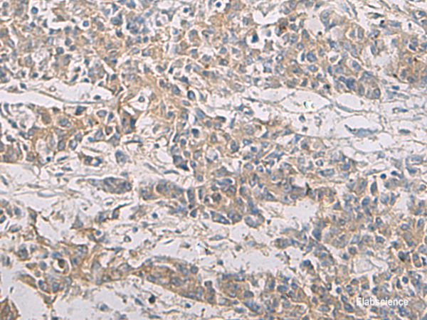 Immunohistochemistry of paraffin-embedded Human colorectal cancer tissue using PA2G4 Polyclonal Antibody at dilution of 1:60(×200)