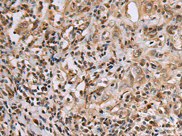 Immunohistochemistry of paraffin-embedded Human esophagus cancer tissue using DNA2 Polyclonal Antibody at dilution of 1:60(×200)