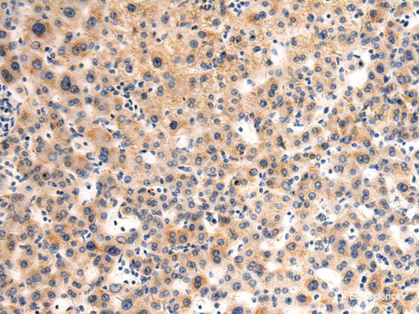 Immunohistochemistry of paraffin-embedded Human liver cancer tissue using GLT8D1 Polyclonal Antibody at dilution of 1:90(×200)