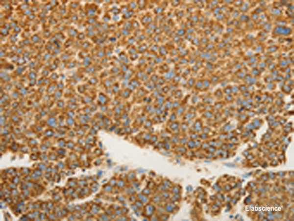 Immunohistochemistry of paraffin-embedded Human liver cancer tissue using VDAC2 Polyclonal Antibody at dilution of 1:25(×200)