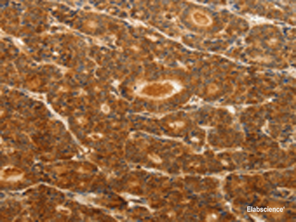 Immunohistochemistry of paraffin-embedded Human thyroid cancer tissue using CDH5 Polyclonal Antibody at dilution of 1:30(×200)