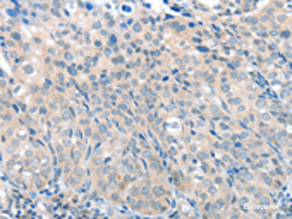Immunohistochemistry of paraffin-embedded Human cervical cancer tissue using SLC17A6 Polyclonal Antibody at dilution of 1:100(×200)
