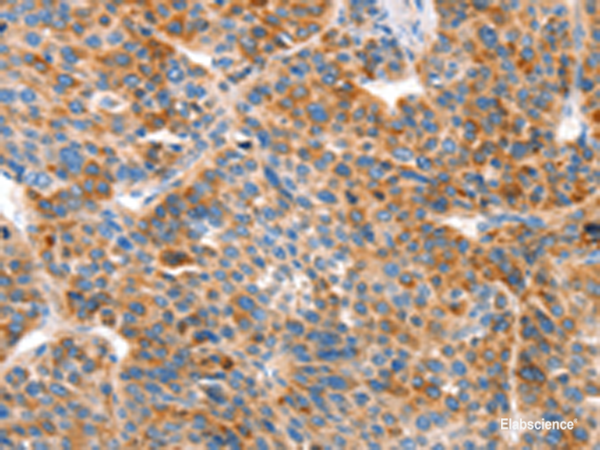 Immunohistochemistry of paraffin-embedded Human liver cancer tissue using VTN Polyclonal Antibody at dilution of 1:100(×200)