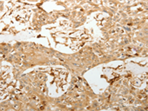 Immunohistochemistry of paraffin-embedded Human esophagus cancer tissue using VMA21 Polyclonal Antibody at dilution of 1:150(×200)