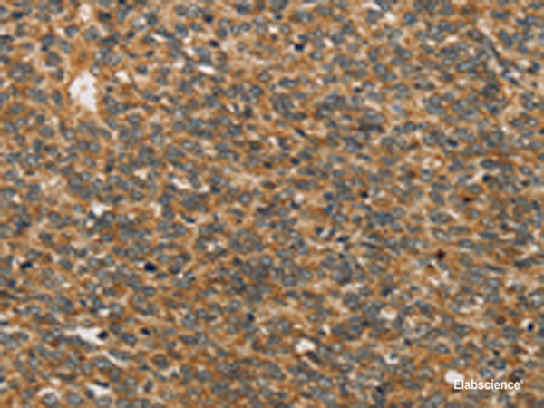 Immunohistochemistry of paraffin-embedded Human ovarian cancer tissue using XPR1 Polyclonal Antibody at dilution of 1:45(×200)