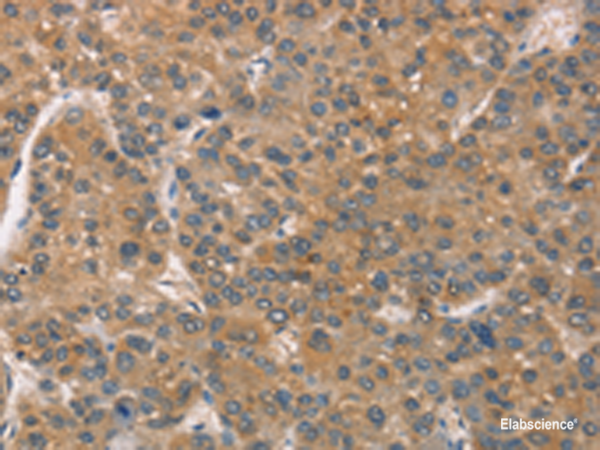 Immunohistochemistry of paraffin-embedded Human liver cancer tissue using ZADH2 Polyclonal Antibody at dilution of 1:51(×200)